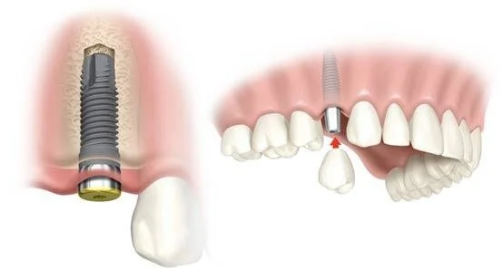 Profi zubní péče: vysoce kvalitní implantát a případně i nasazení korunky nebo můstku