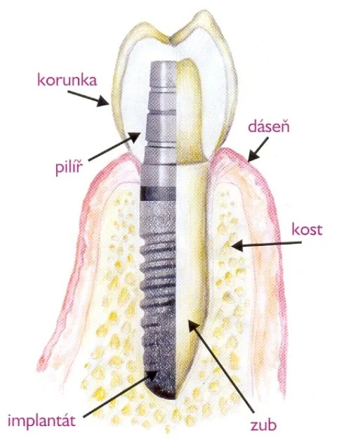 Profi zubní péče: vysoce kvalitní implantát a případně i nasazení korunky nebo můstku