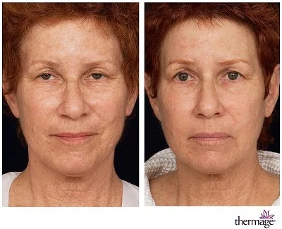 Omládněte o pár let: neinvazivní účinný lifting CPT Thermage nebo EMfacelift