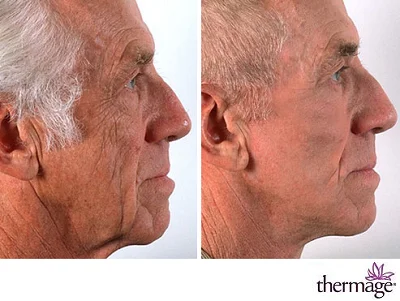 Omládněte o pár let: neinvazivní účinný lifting CPT Thermage nebo EMfacelift