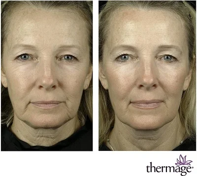 Omládněte o pár let: neinvazivní účinný lifting CPT Thermage nebo EMfacelift