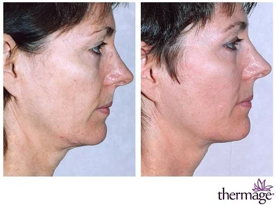 Omládněte o pár let: neinvazivní účinný lifting CPT Thermage nebo EMfacelift