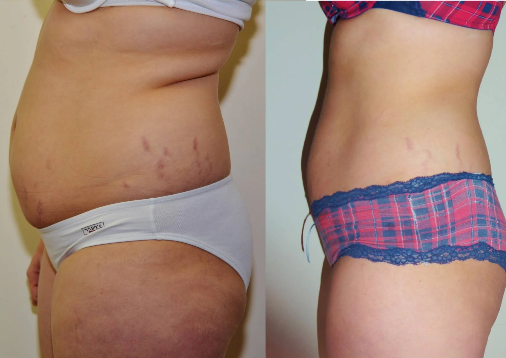 Konec přebytečným tukům a celulitidě: až 5 ošetření ultrazvukovou liposukcí a přístrojovou lymfodrenáží