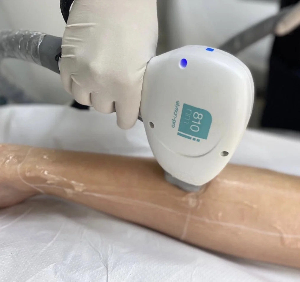 Dejte sbohem chloupkům: laserová epilace přístrojem Elysion Pro