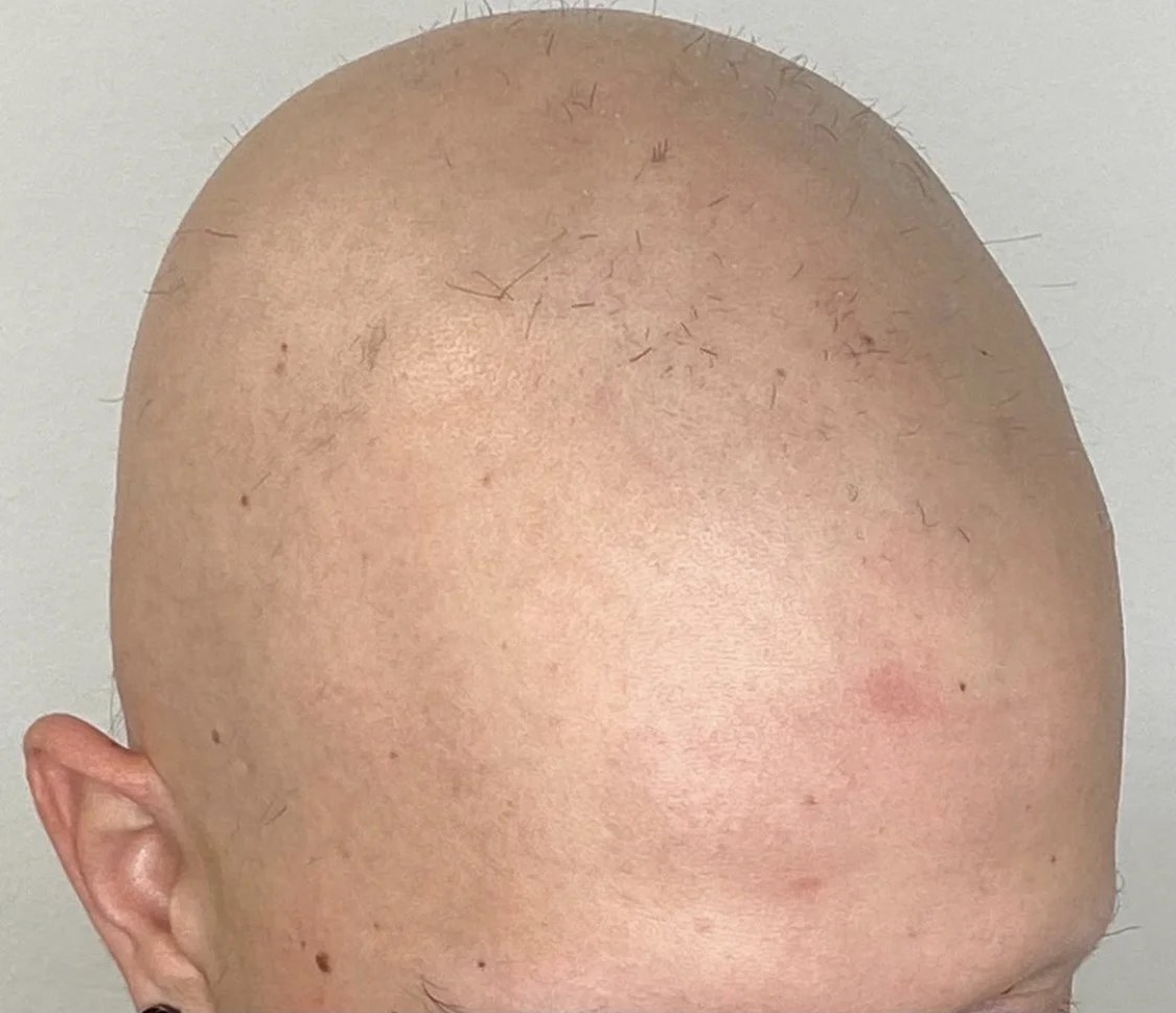 Zahuštění vlasů pomocí mikropigmentace pro muže i ženy: kouty i celá hlava
