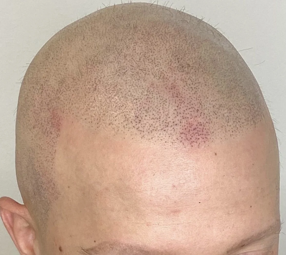 Zahuštění vlasů pomocí mikropigmentace pro muže i ženy: kouty i celá hlava