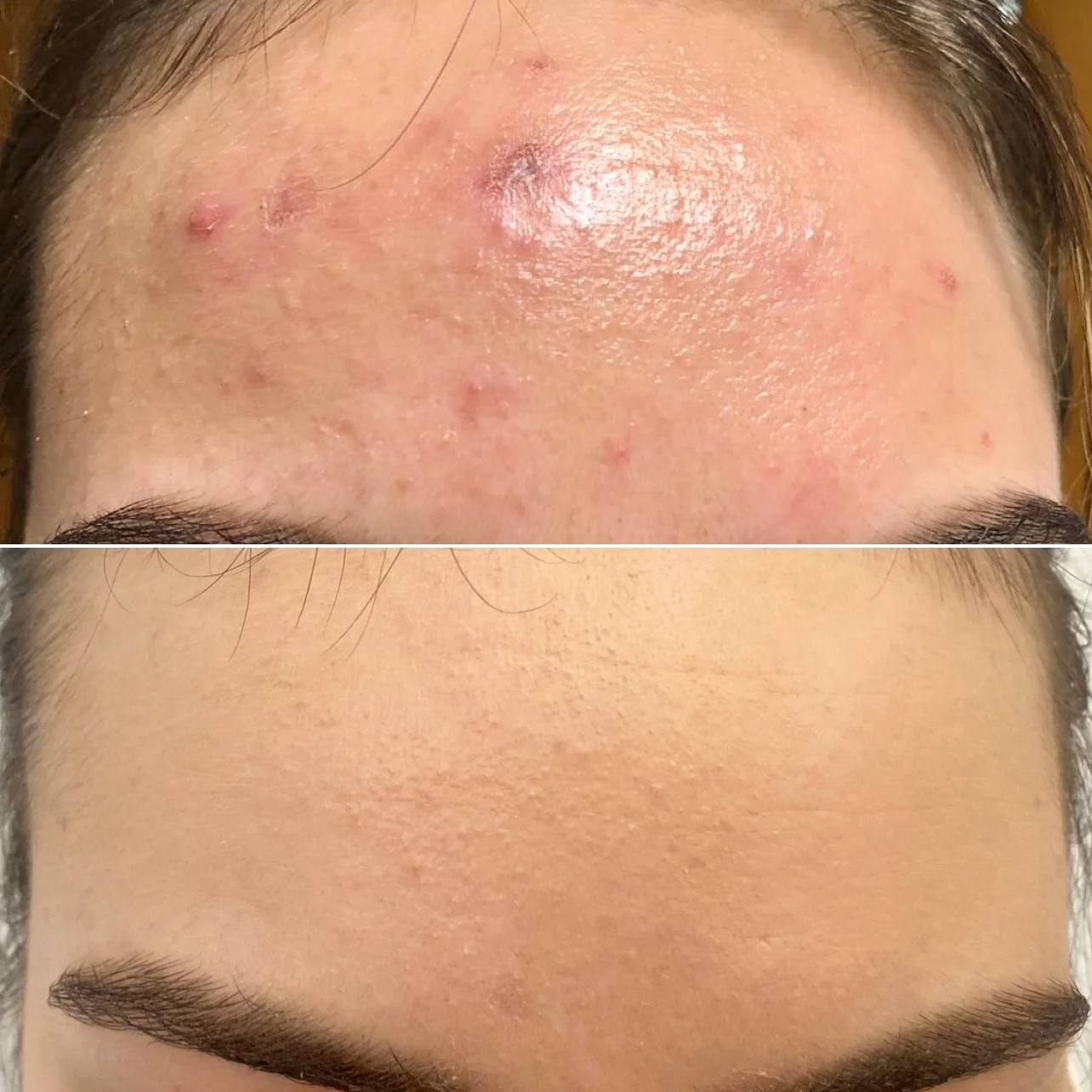 Chemický peeling obličeje, krku a dekoltu včetně hloubkového čištění pleti
