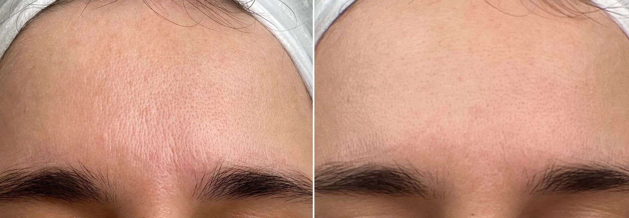 Chemický peeling obličeje, krku a dekoltu včetně hloubkového čištění pleti