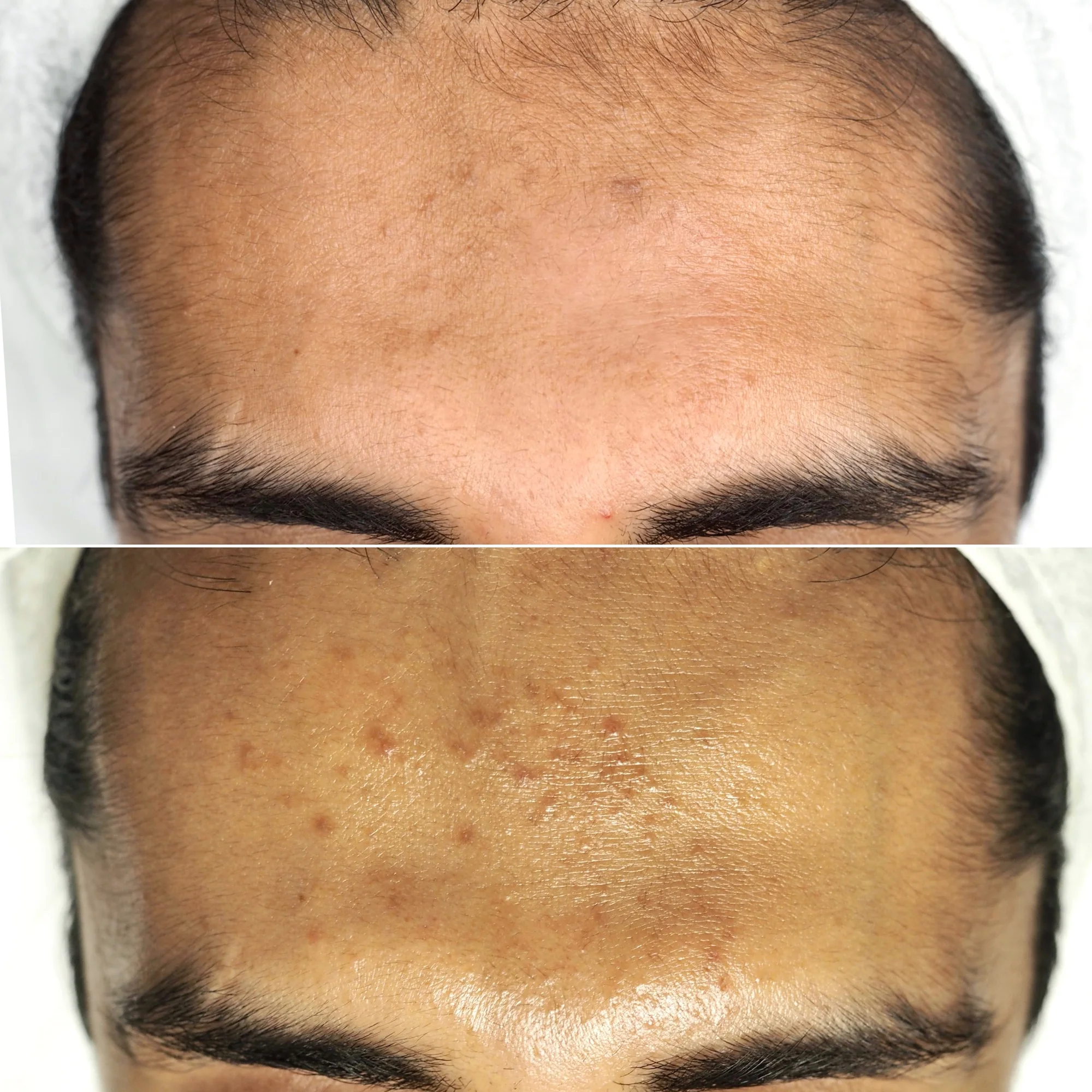 Chemický peeling obličeje, krku a dekoltu včetně hloubkového čištění pleti