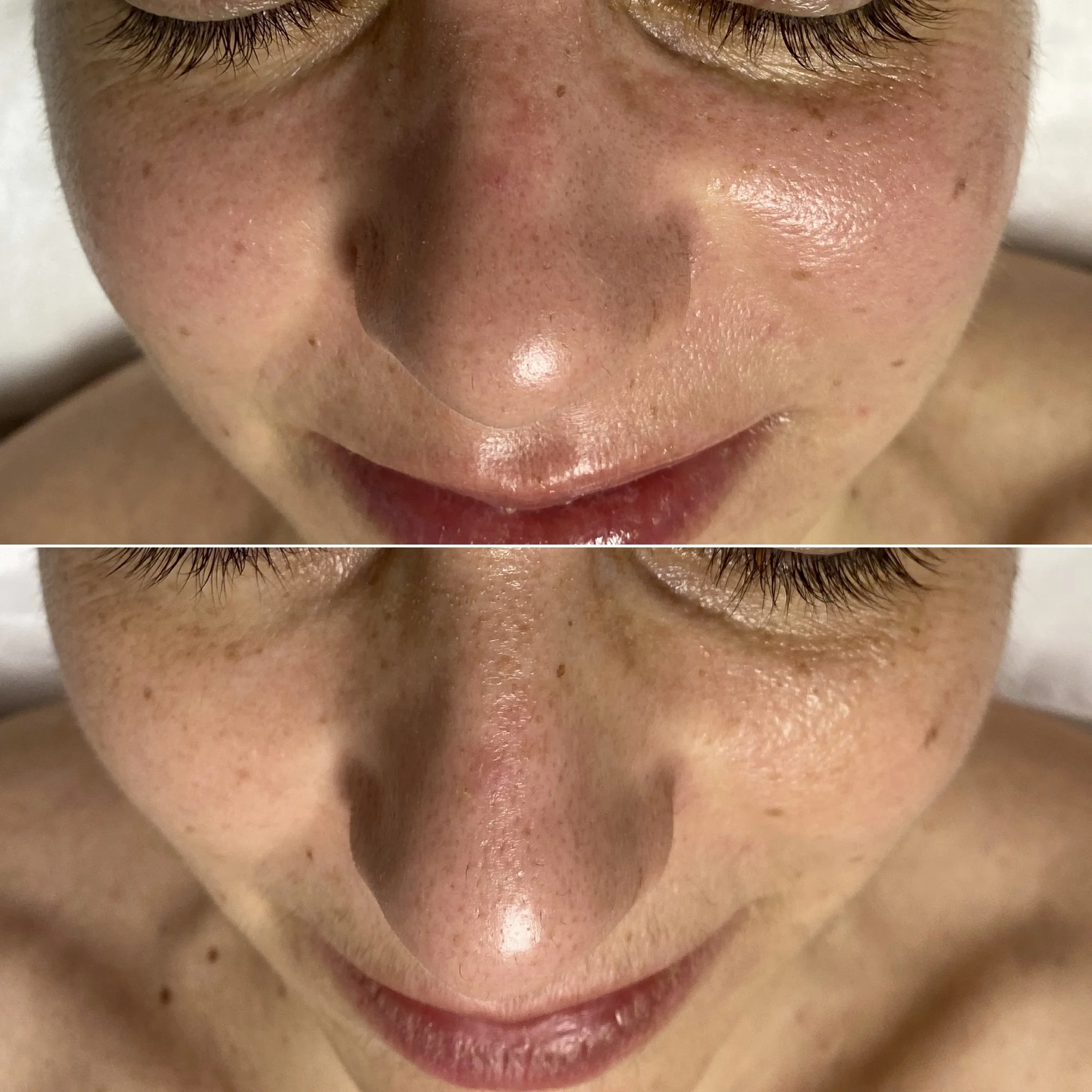 Chemický peeling obličeje, krku a dekoltu včetně hloubkového čištění pleti