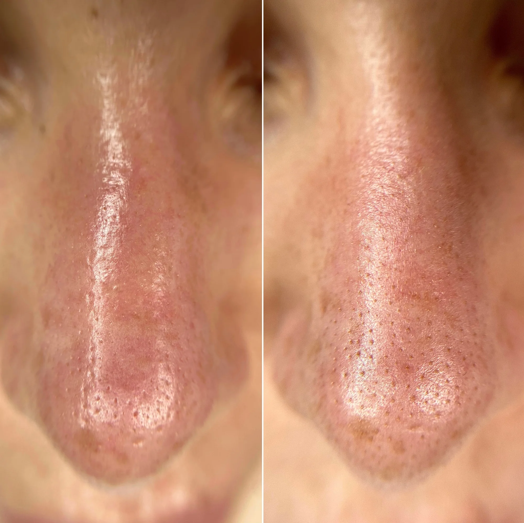 Chemický peeling obličeje, krku a dekoltu včetně hloubkového čištění pleti