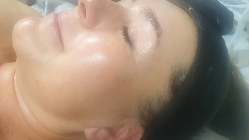 Zářivá pleť: Mikrojehličkové ošetření vč. světelné terapie
