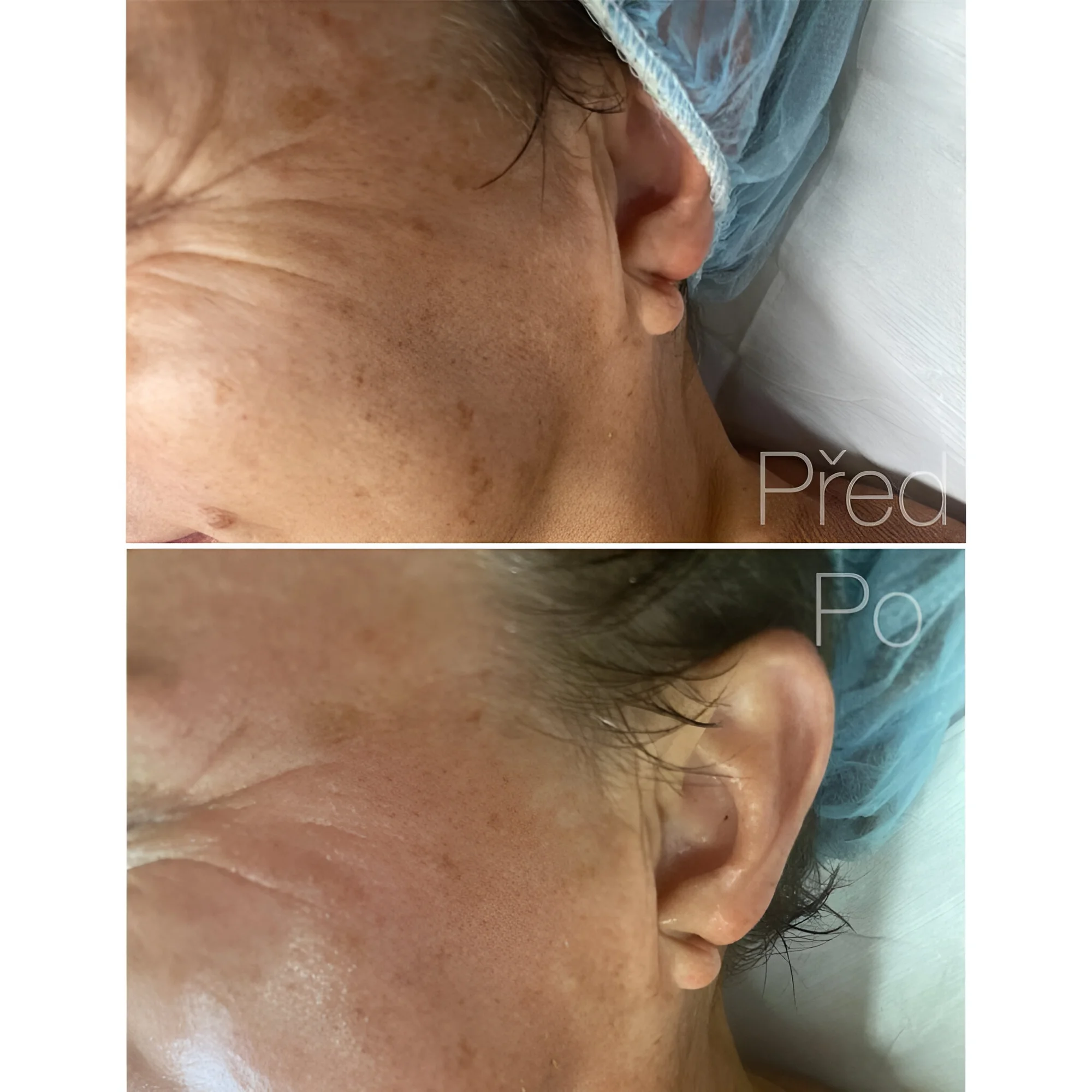 Kosmetické bylinné ošetření pleti Green Peel pro osvěžení i energii