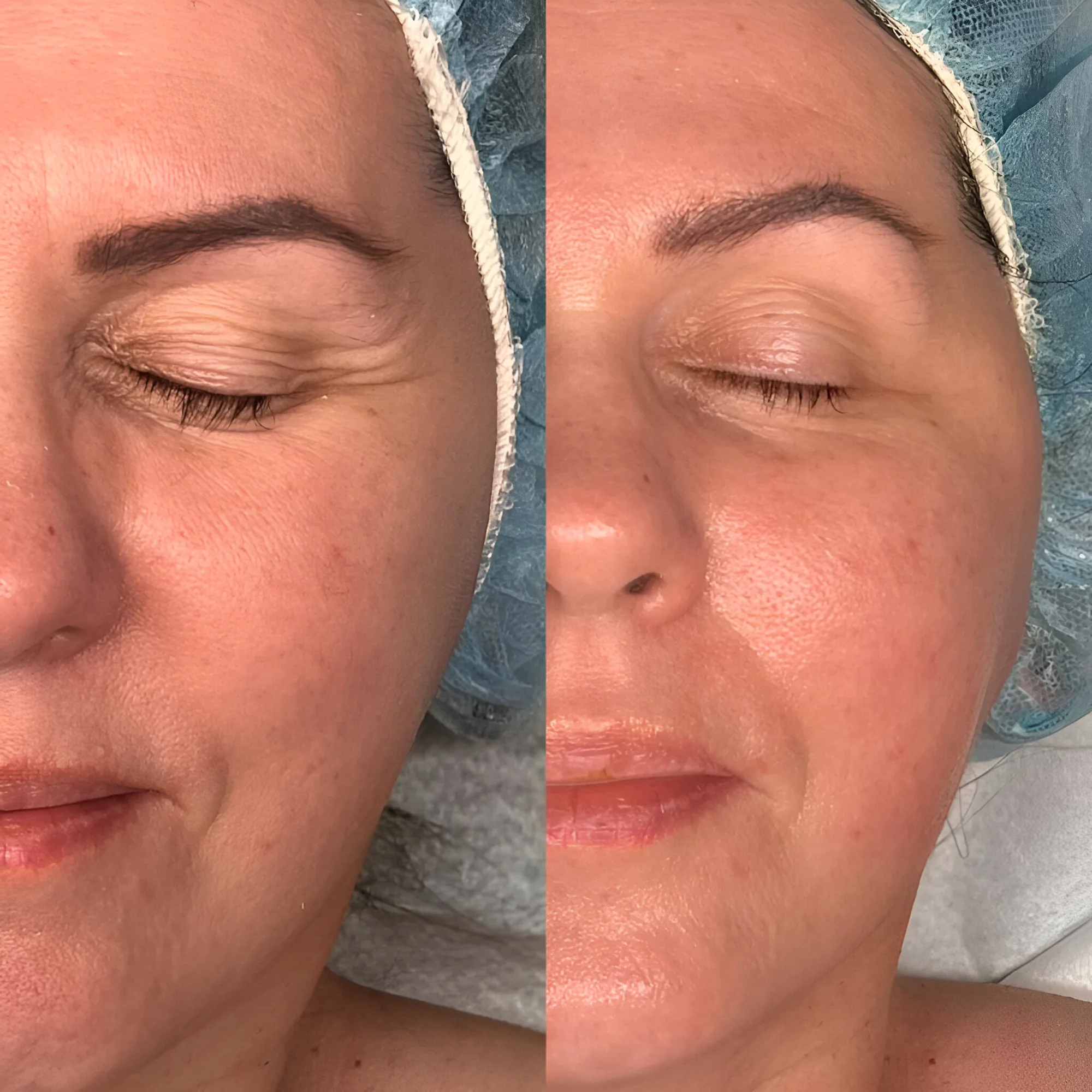 Kosmetické bylinné ošetření pleti Green Peel pro osvěžení i energii