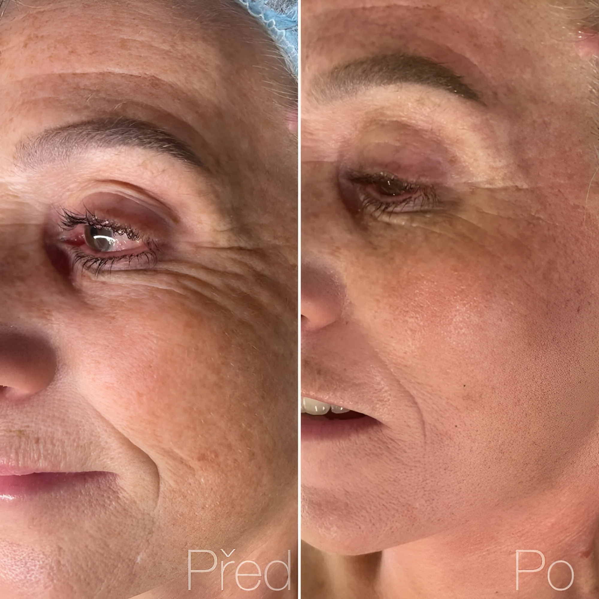 Kosmetické bylinné ošetření pleti Green Peel pro osvěžení i energii