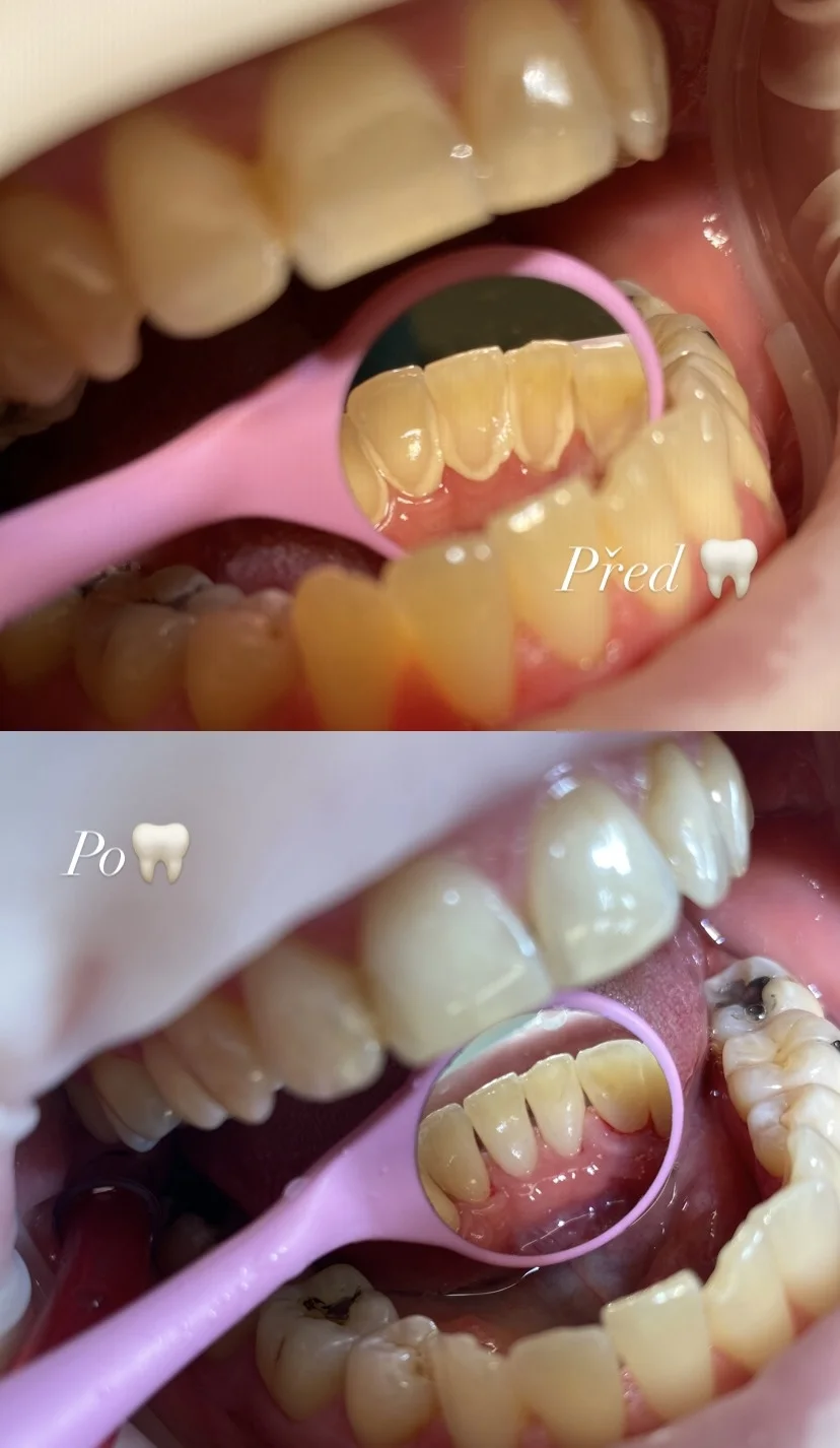 Vstupní vyšetření na dentální hygieně pro zářivý a zdravý úsměv