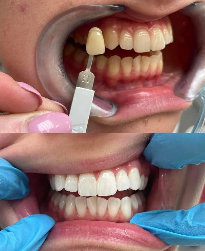 Vstupní vyšetření na dentální hygieně pro zářivý a zdravý úsměv