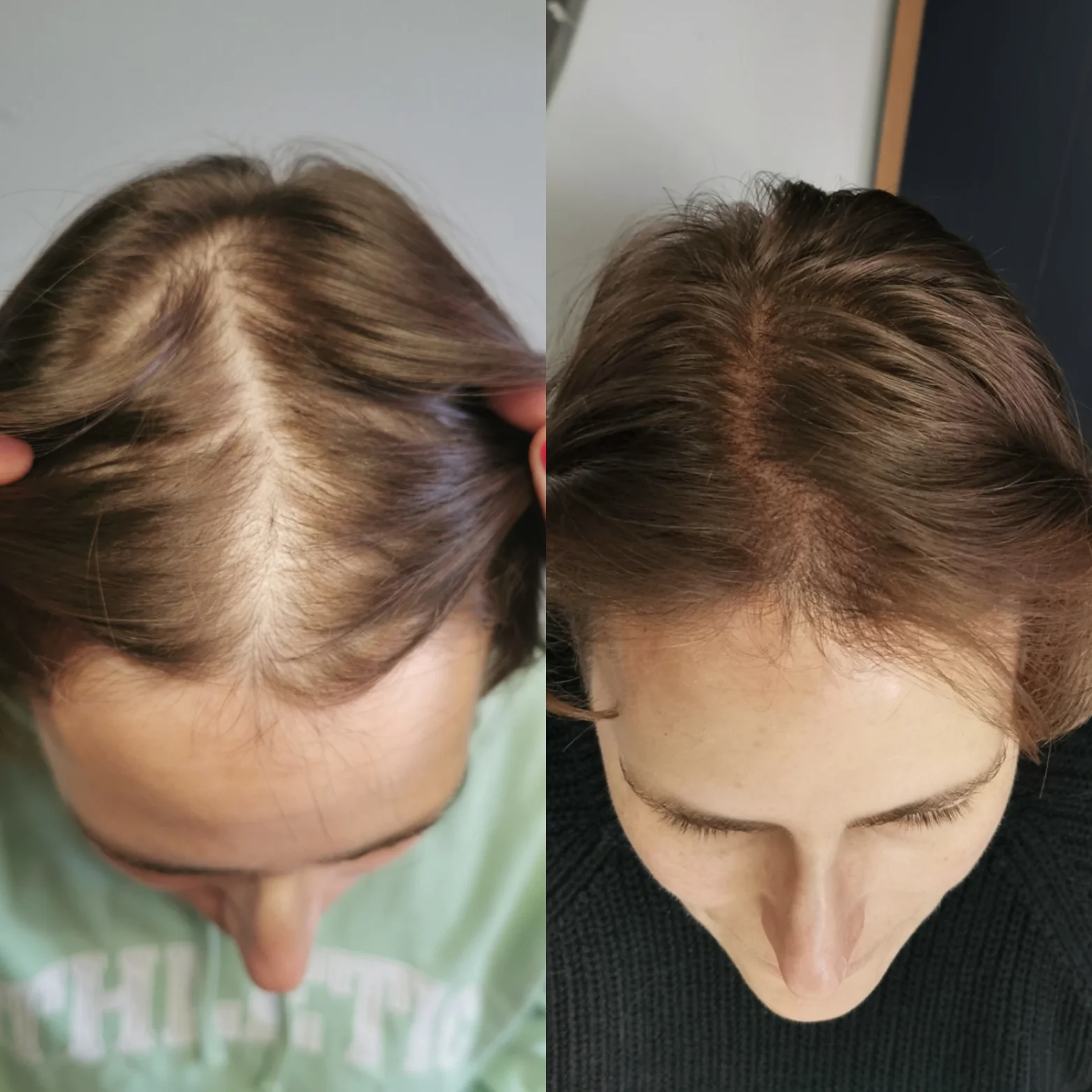 Z pleše strniště: tetování vlasů mikropigmentací