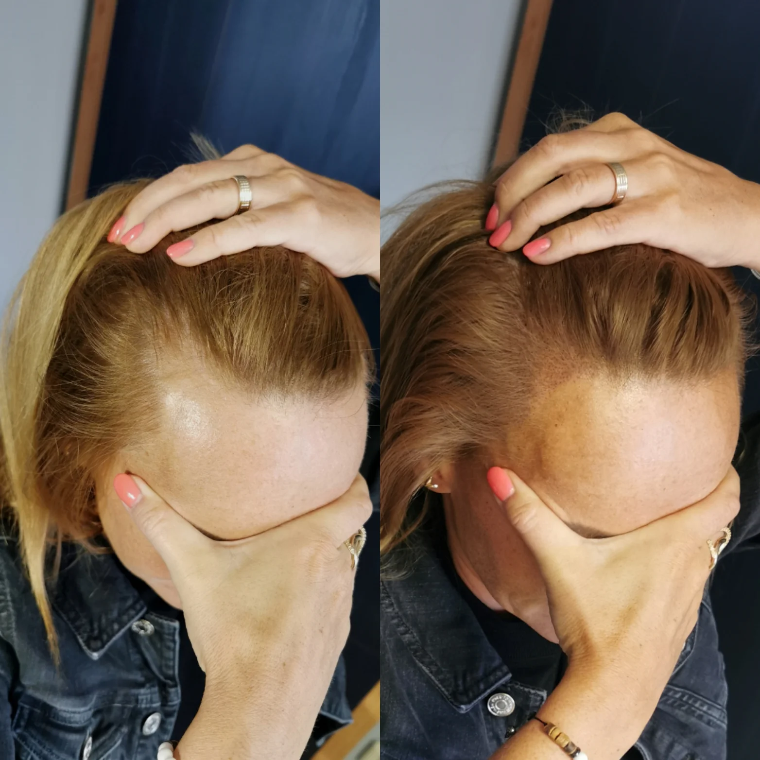 Z pleše strniště: tetování vlasů mikropigmentací