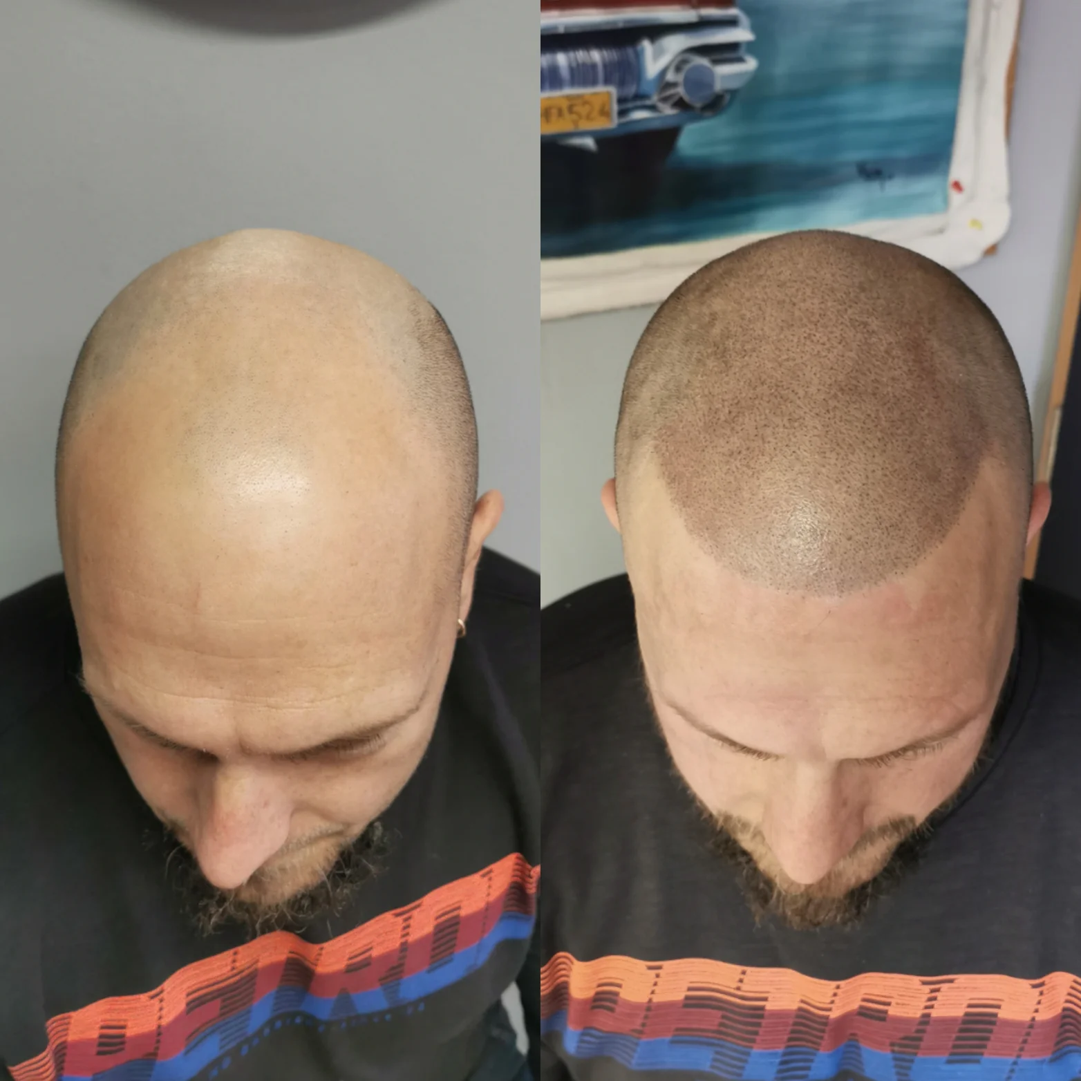 Z pleše strniště: tetování vlasů mikropigmentací