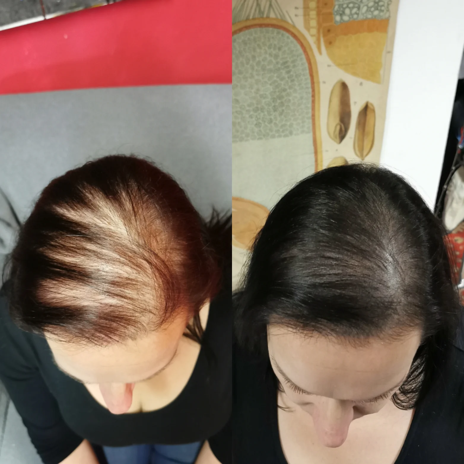 Z pleše strniště: tetování vlasů mikropigmentací