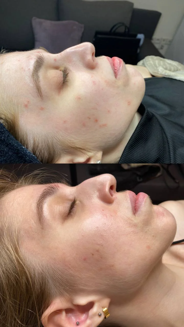 Omlazení pleti: lifting, ultrazvukové či manuální čištění, karboxyterapie, TC Plus peeling nebo mezoterapie