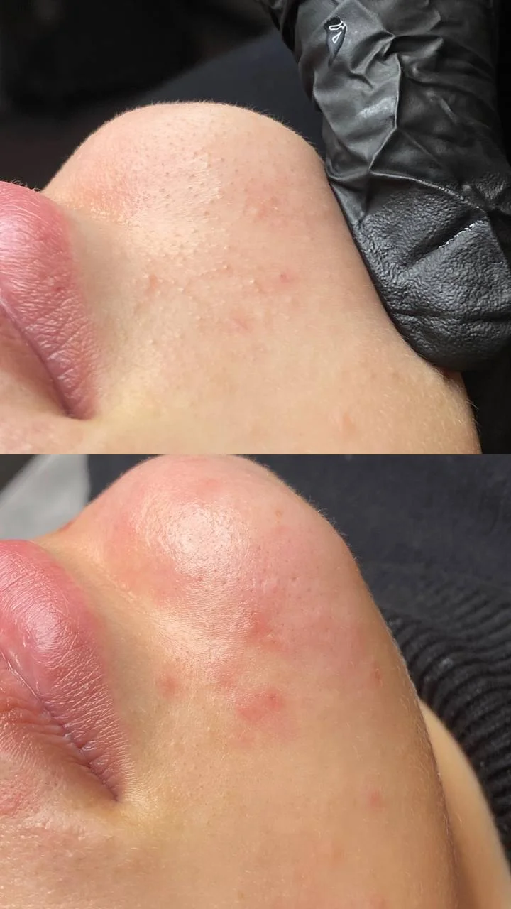 Omlazení pleti: lifting, ultrazvukové či manuální čištění, karboxyterapie, TC Plus peeling nebo mezoterapie
