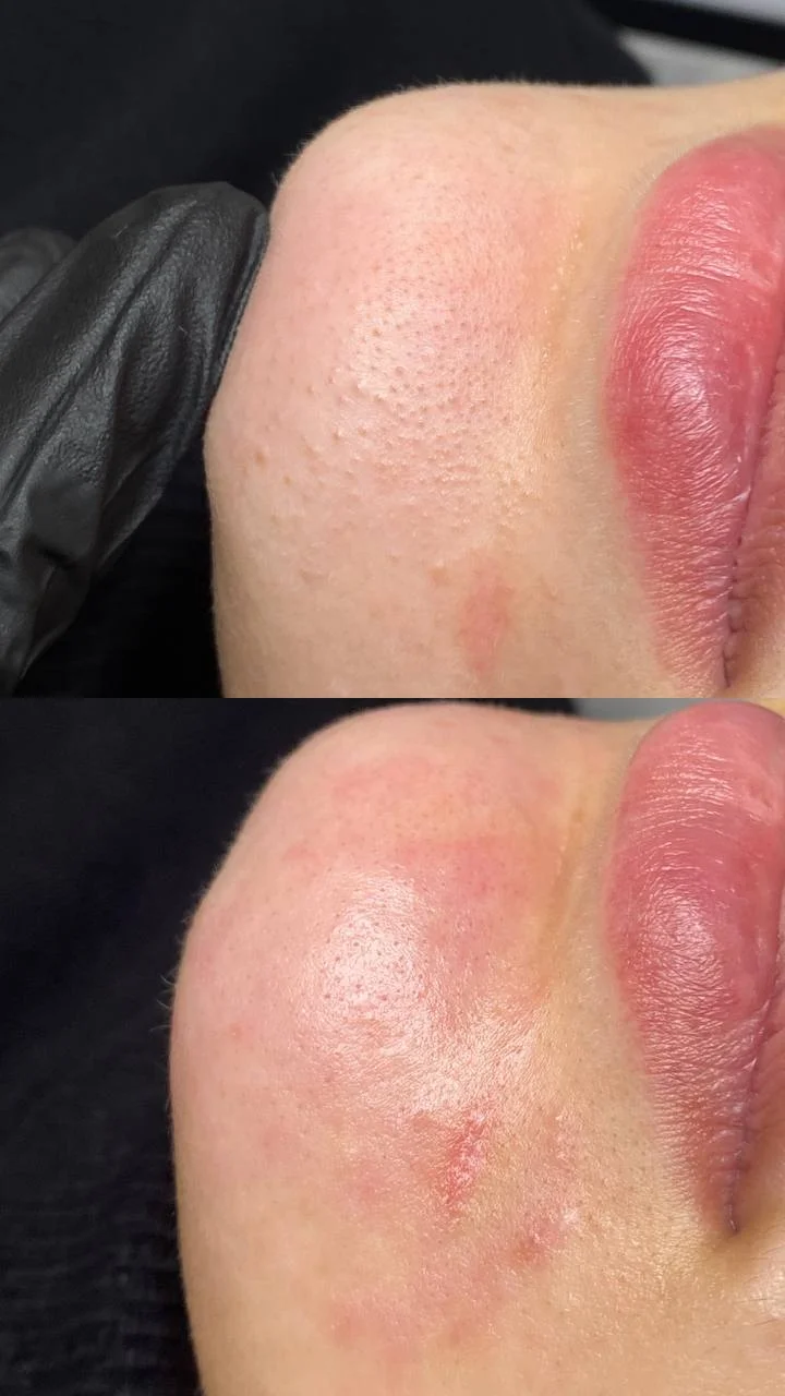 Omlazení pleti: lifting, ultrazvukové či manuální čištění, karboxyterapie, TC Plus peeling nebo mezoterapie