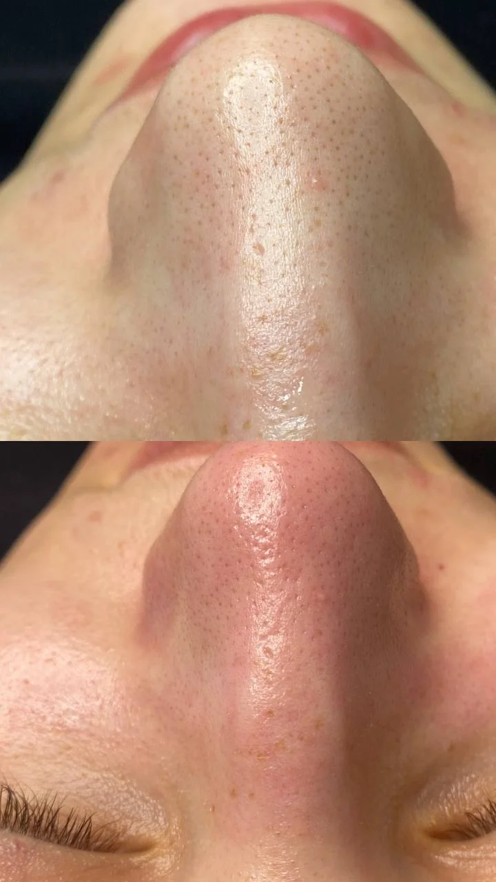 Omlazení pleti: lifting, ultrazvukové či manuální čištění, karboxyterapie, TC Plus peeling nebo mezoterapie