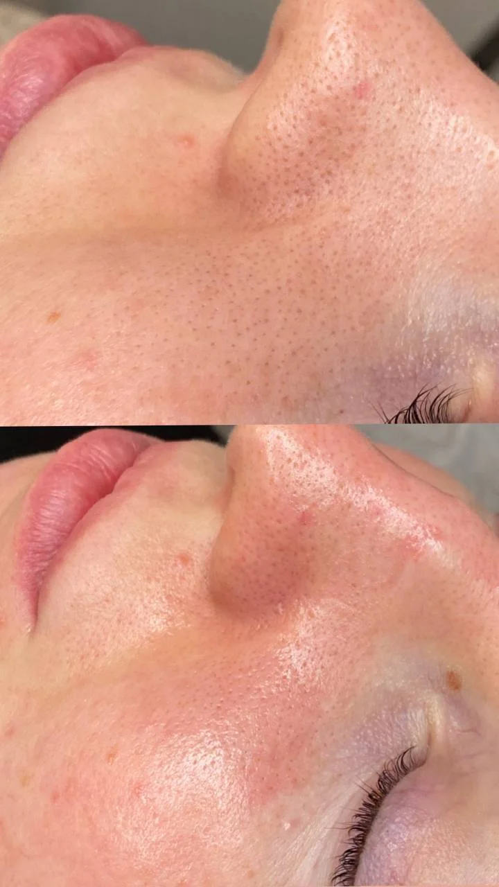 Omlazení pleti: lifting, ultrazvukové či manuální čištění, karboxyterapie, TC Plus peeling nebo mezoterapie