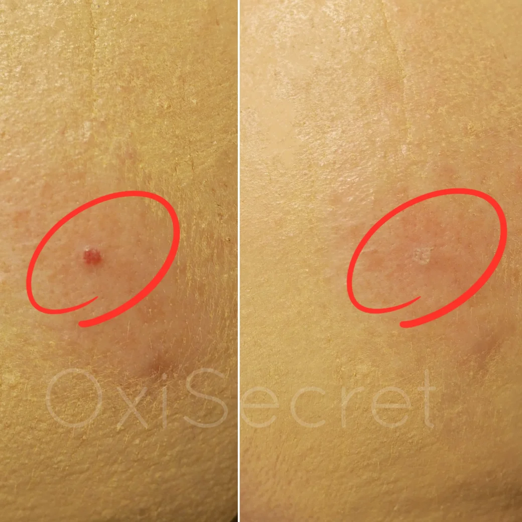 Okamžité odstranění kožních výrůstků: hemangiomů, fibrom či milií přístrojem Onetec