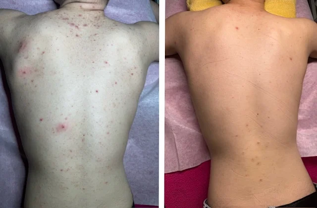 Kosmetické ošetření pro muže: pro aknózní záda či péče pro všechny typy pleti