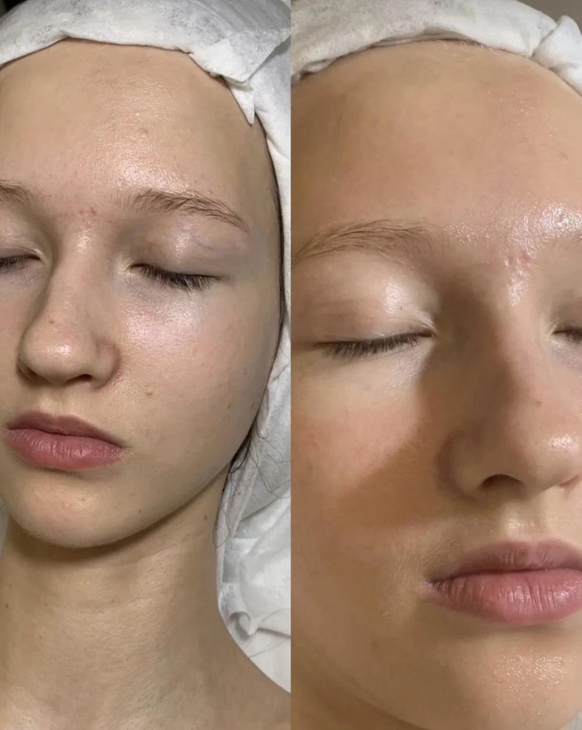 Péče pro všechny typy pleti: chemický peeling, masáž, karboxyterapie i mikrojehličkování