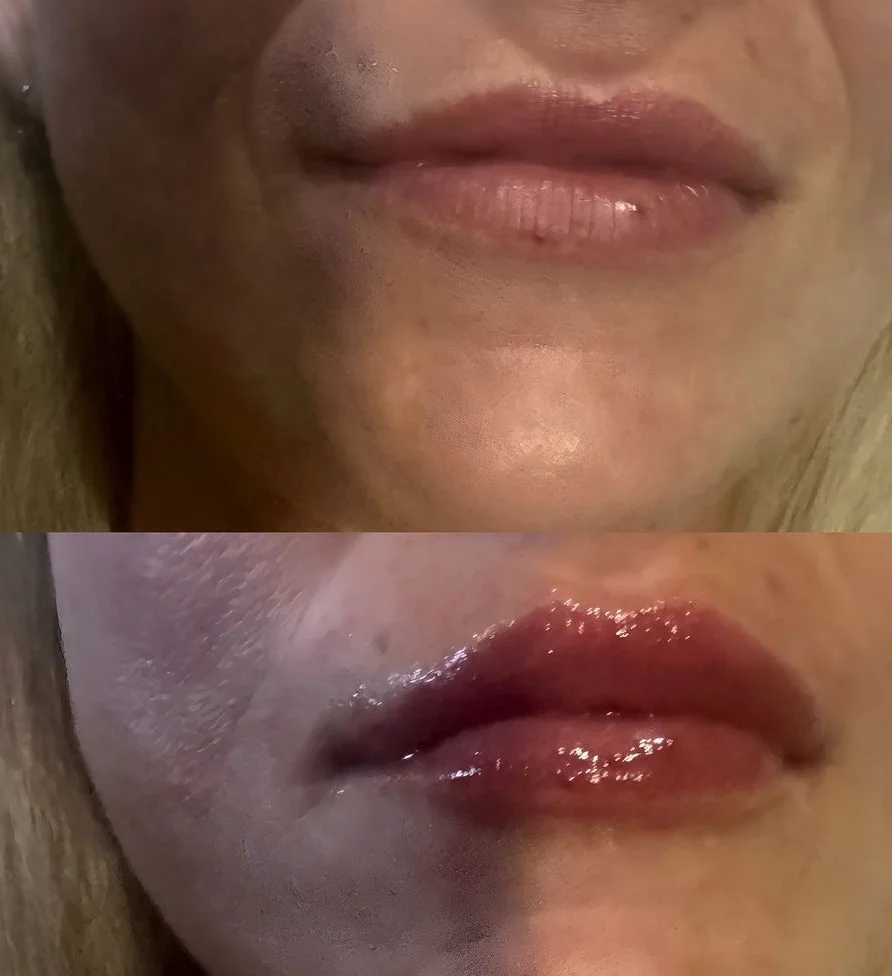 Hyaluron pen pro jemnou výplň rtů, zvýraznění kontur v obličeji i zjemnění vrásek