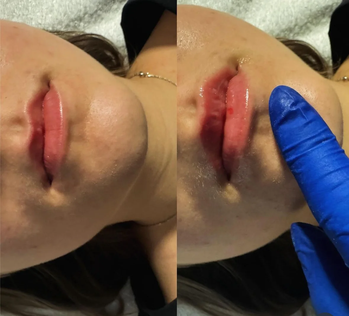 Hyaluron pen pro jemnou výplň rtů, zvýraznění kontur v obličeji i zjemnění vrásek