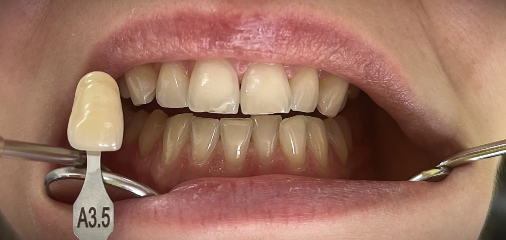 Dentální hygiena vč. pískování zubů nebo set na domácí bělení zubů