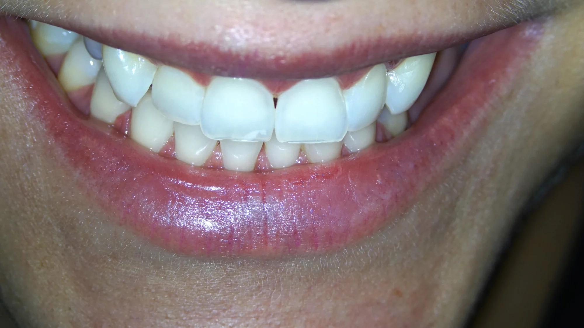 Dentální hygiena vč. pískování zubů nebo set na domácí bělení zubů