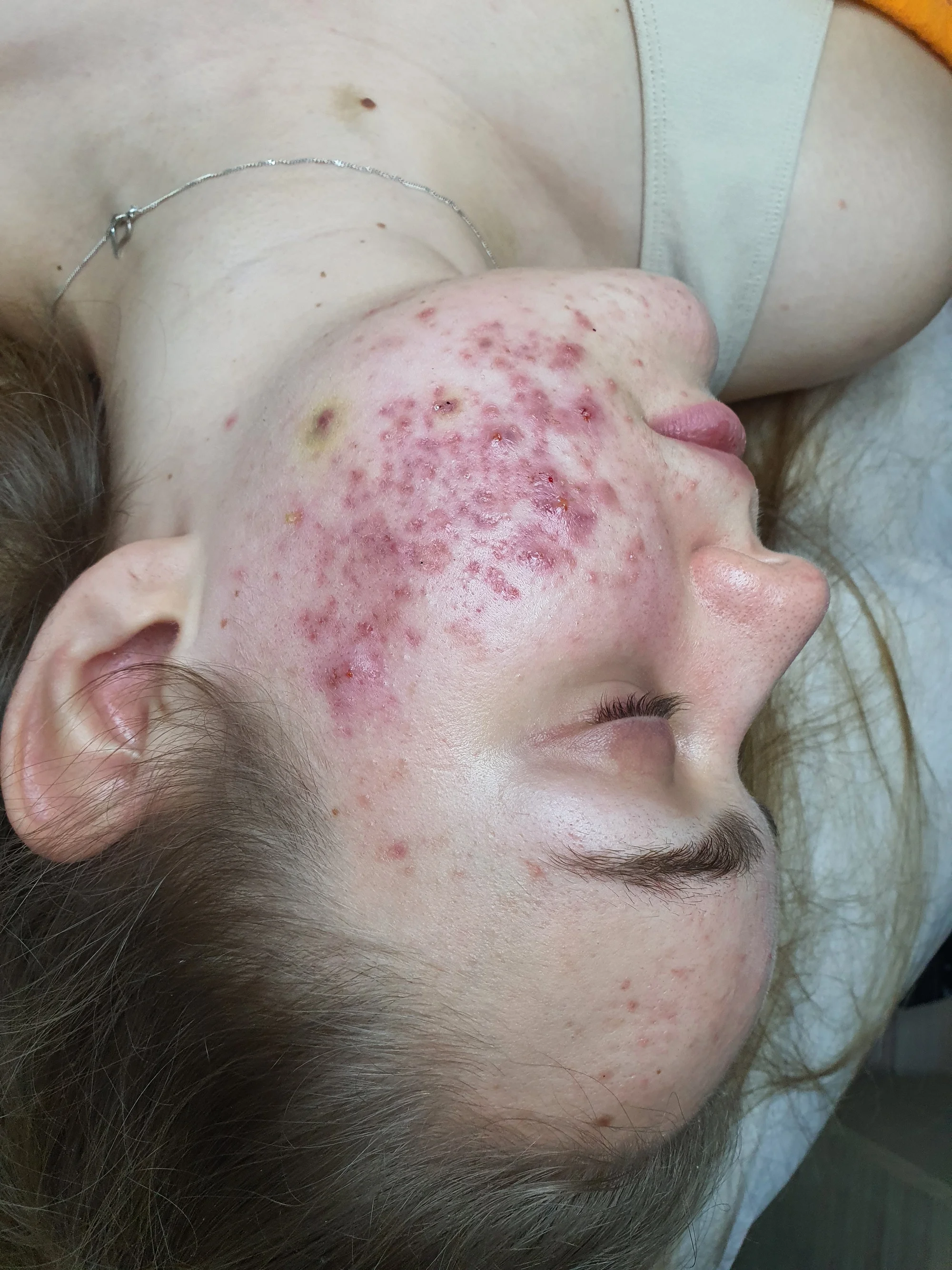 Kosmetické ošetření Lasocare®: anti-aging omlazení pleti nebo péče proti akné