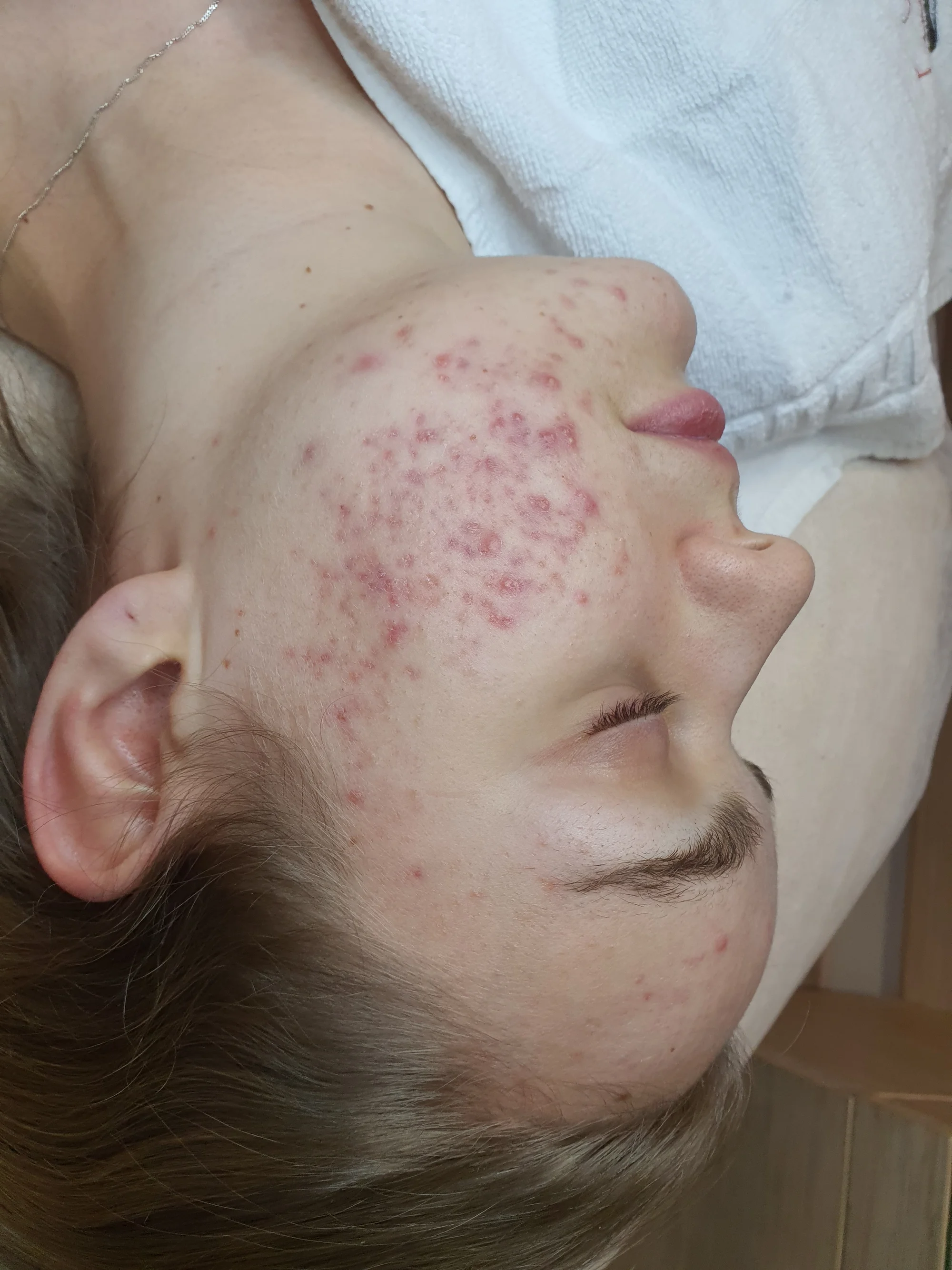 Kosmetické ošetření Lasocare®: anti-aging omlazení pleti nebo péče proti akné