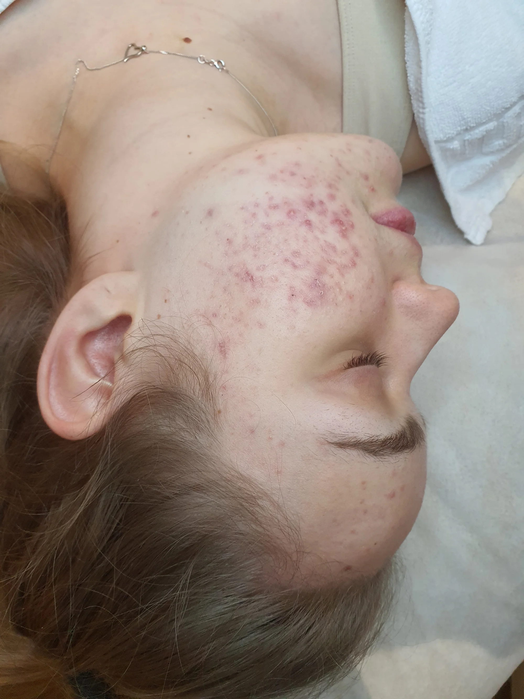 Kosmetické ošetření Lasocare®: anti-aging omlazení pleti nebo péče proti akné