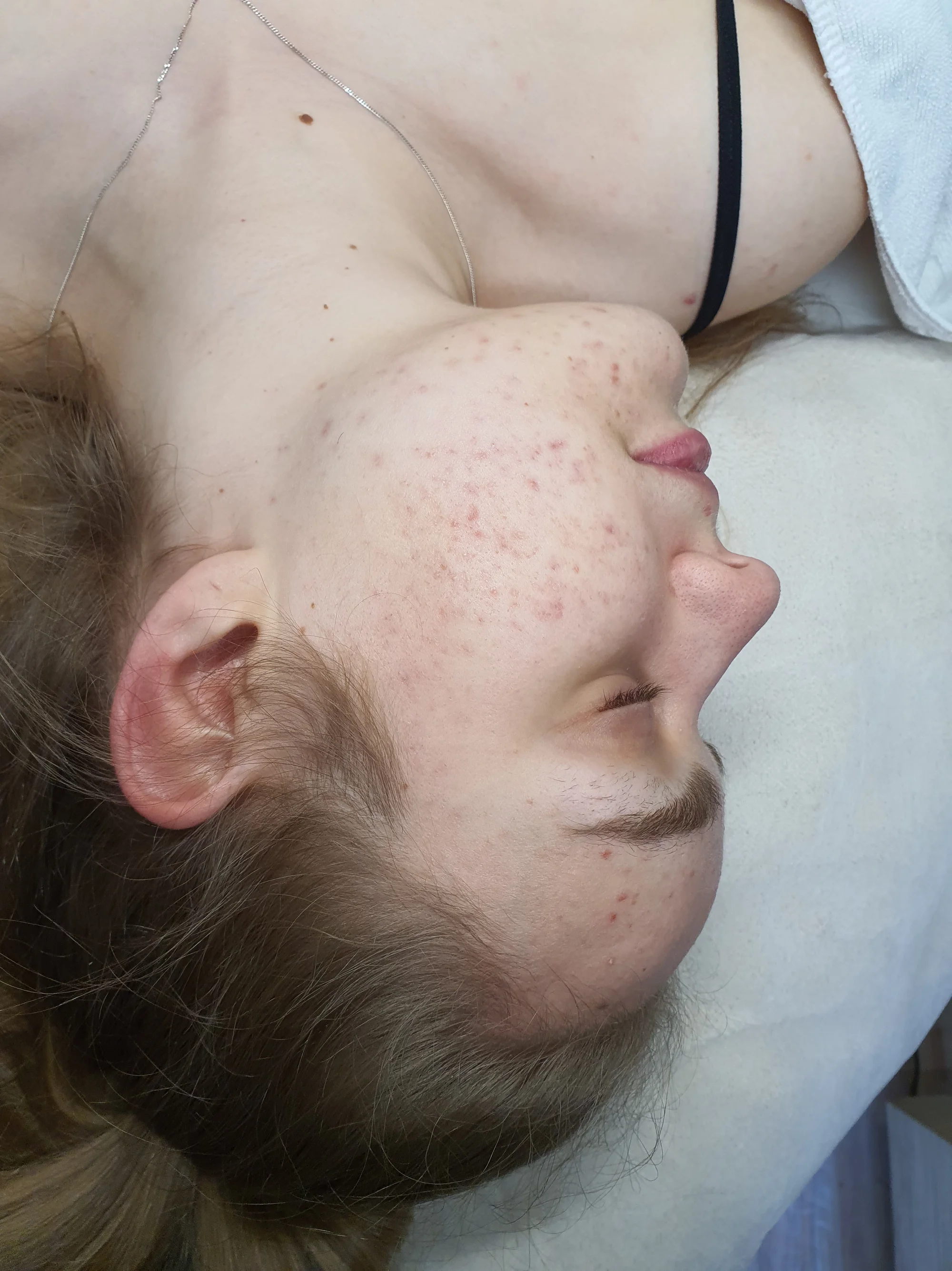 Kosmetické ošetření Lasocare®: anti-aging omlazení pleti nebo péče proti akné