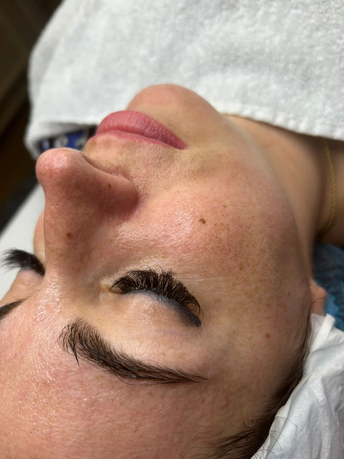 Kosmetická péče proti vráskám, akné i pigmentovým skvrnám: nanoneedling i biomicroneedling