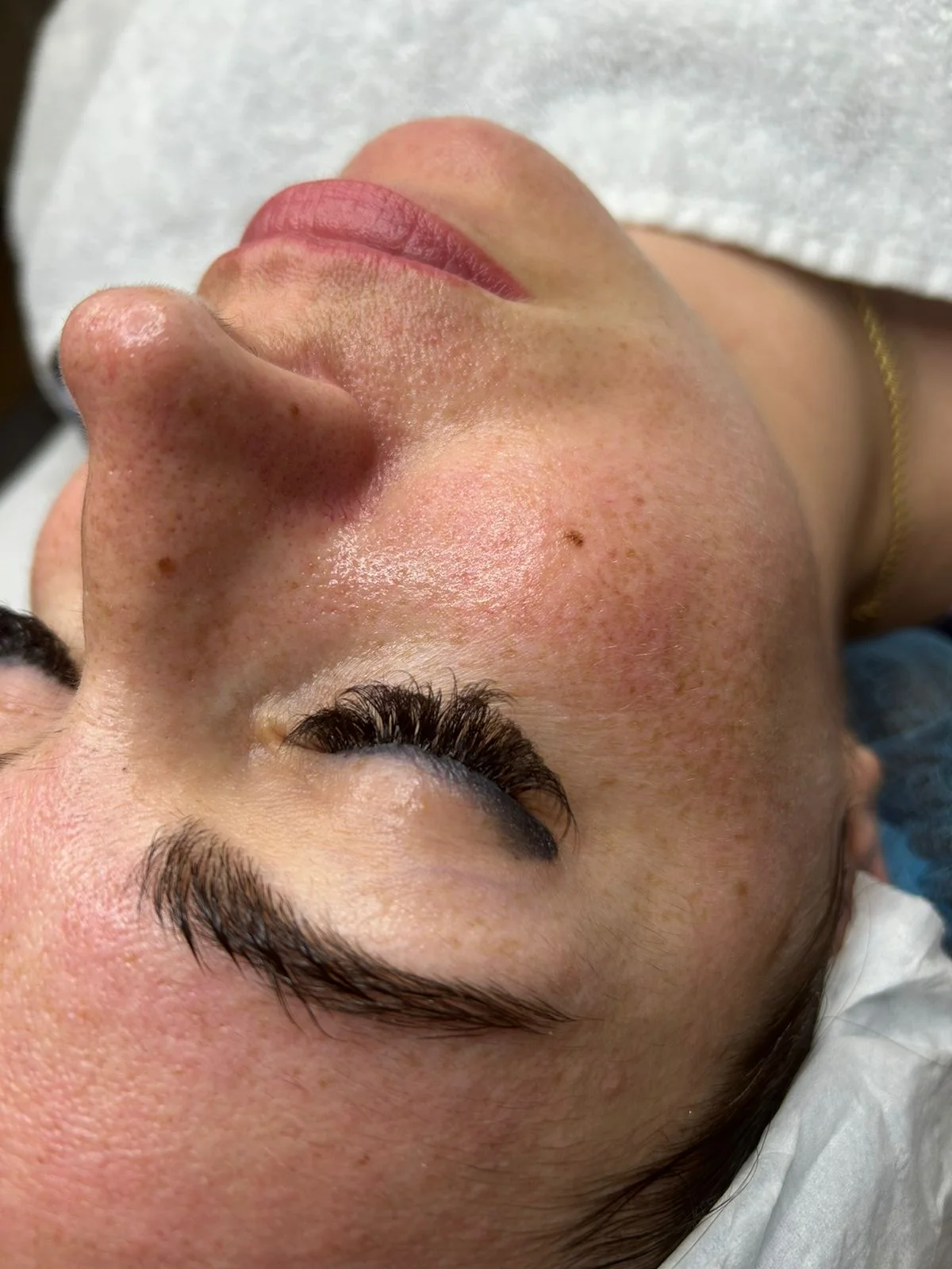 Kosmetická péče proti vráskám, akné i pigmentovým skvrnám: nanoneedling i biomicroneedling