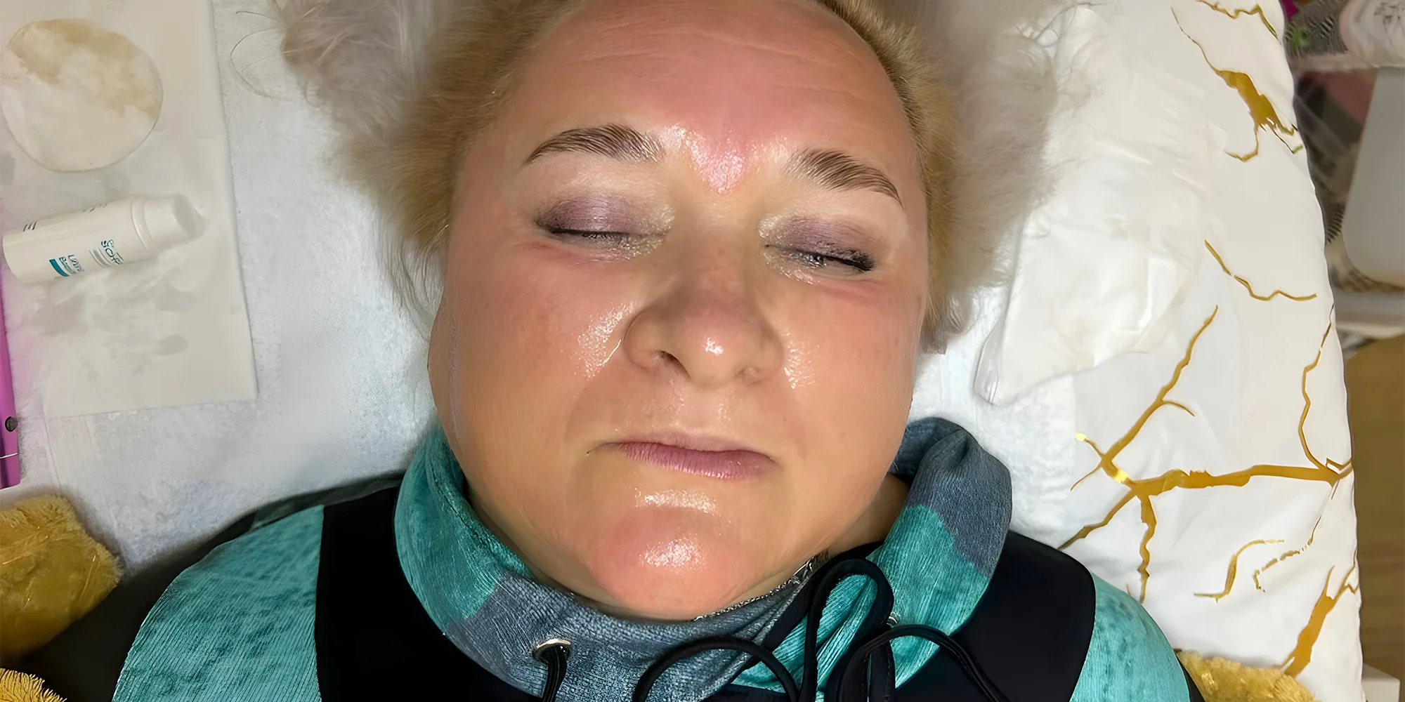 Mikrojehličkovaní pomocí Dermapen pro omlazení a obnovu pleti