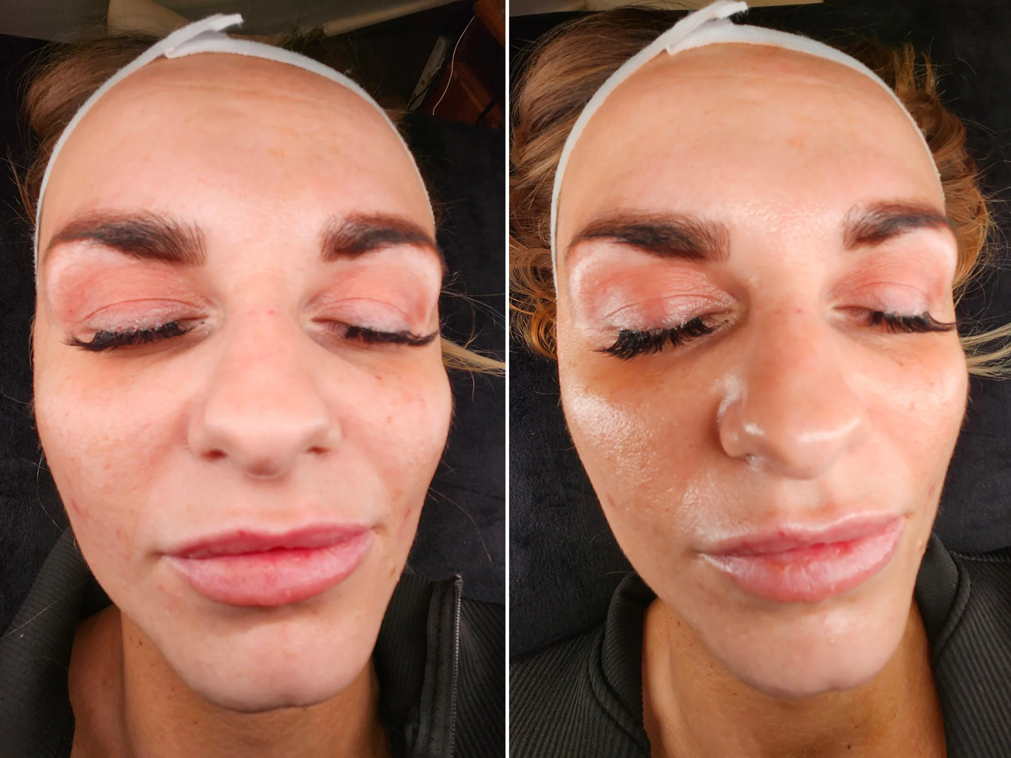Kosmetická péče proti vráskám, akné i pigmentovým skvrnám: nanoneedling i biomicroneedling