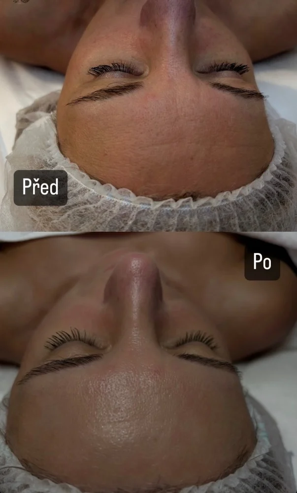 Čištění pleti, anti-age ošetření, mikrojehličkování i balíček se zvlhčovacím sérem a alginátovou maskou
