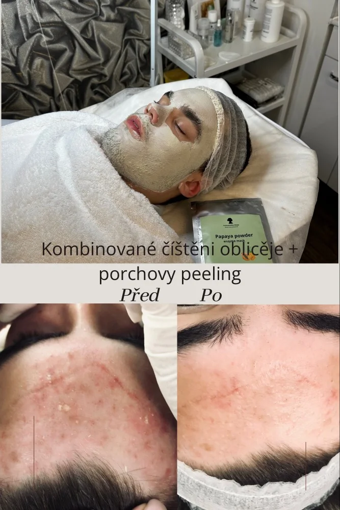Čištění pleti, anti-age ošetření, mikrojehličkování i balíček se zvlhčovacím sérem a alginátovou maskou
