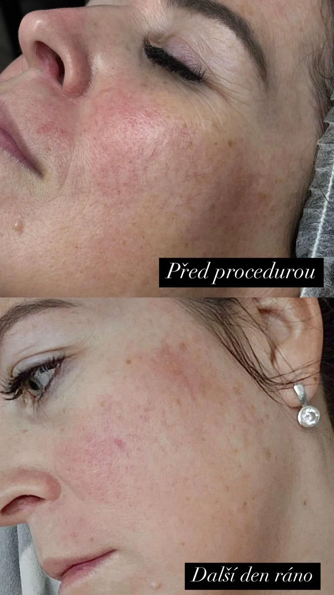 Hloubkové čištění pleti pomocí karbonového peelingu: 1 nebo 3 ošetření