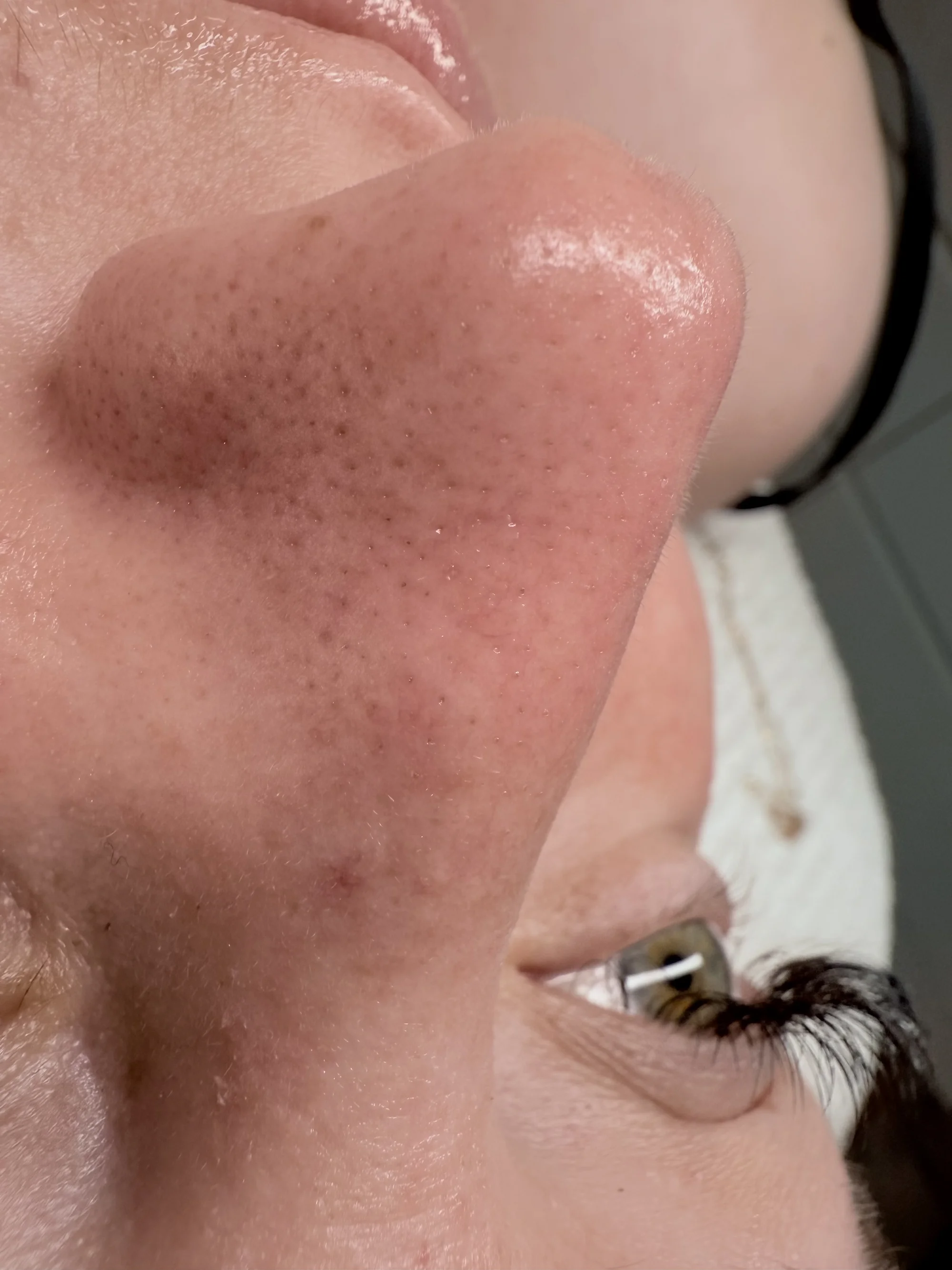 Kompletní péče o pleť: hloubkové čištění, peeling, masáž i mikrojehličkování