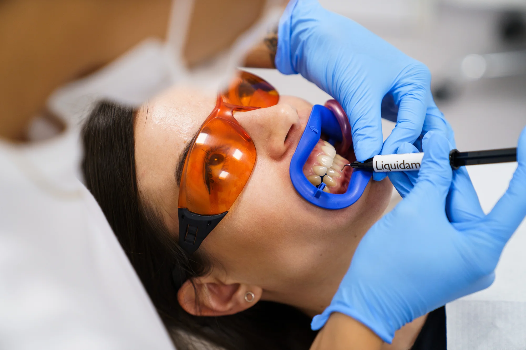 Ordinační bělení zubů LED lampou Philips Zoom s možností dentální hygieny